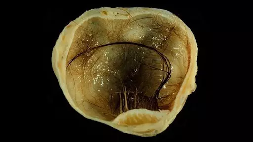 U nang bì buồng trứng chứa các cấu trúc như tóc, lông, bã đậu